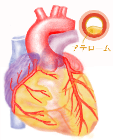 http://www.m-junkanki.com/heart_diseases/ch_p/atherome.gif