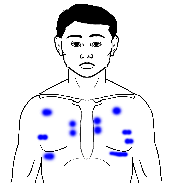 左 胸 の 痛み